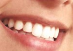implantes-dentarios-natal-1414509241