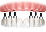 proteses-natal-1414514445